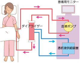 血液透析の図