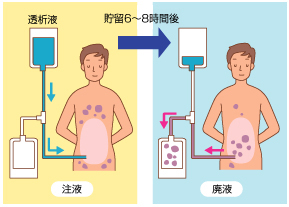 腹膜透析の図