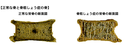 正常な骨と骨粗しょう症の骨の図