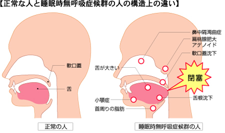 正常な人と睡眠時無呼吸症候群の人の構造上の違いの図