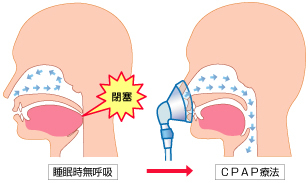 ＣＰＡＰ療法の図