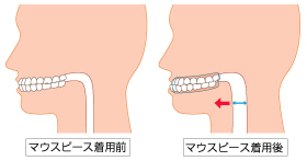 マウスピースの図