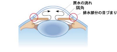 原発開放隅角（ぐうかく）緑内障のイラスト