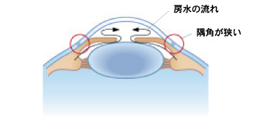 イラス原発閉塞隅角緑内障の図