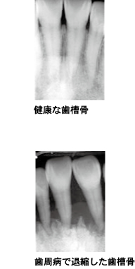健康な歯槽骨と歯周病で退縮した歯槽骨の写真