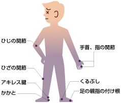 痛風の起こりやすい箇所のイラスト